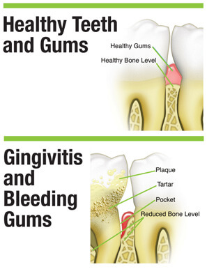 How do you cure gum bleeding?